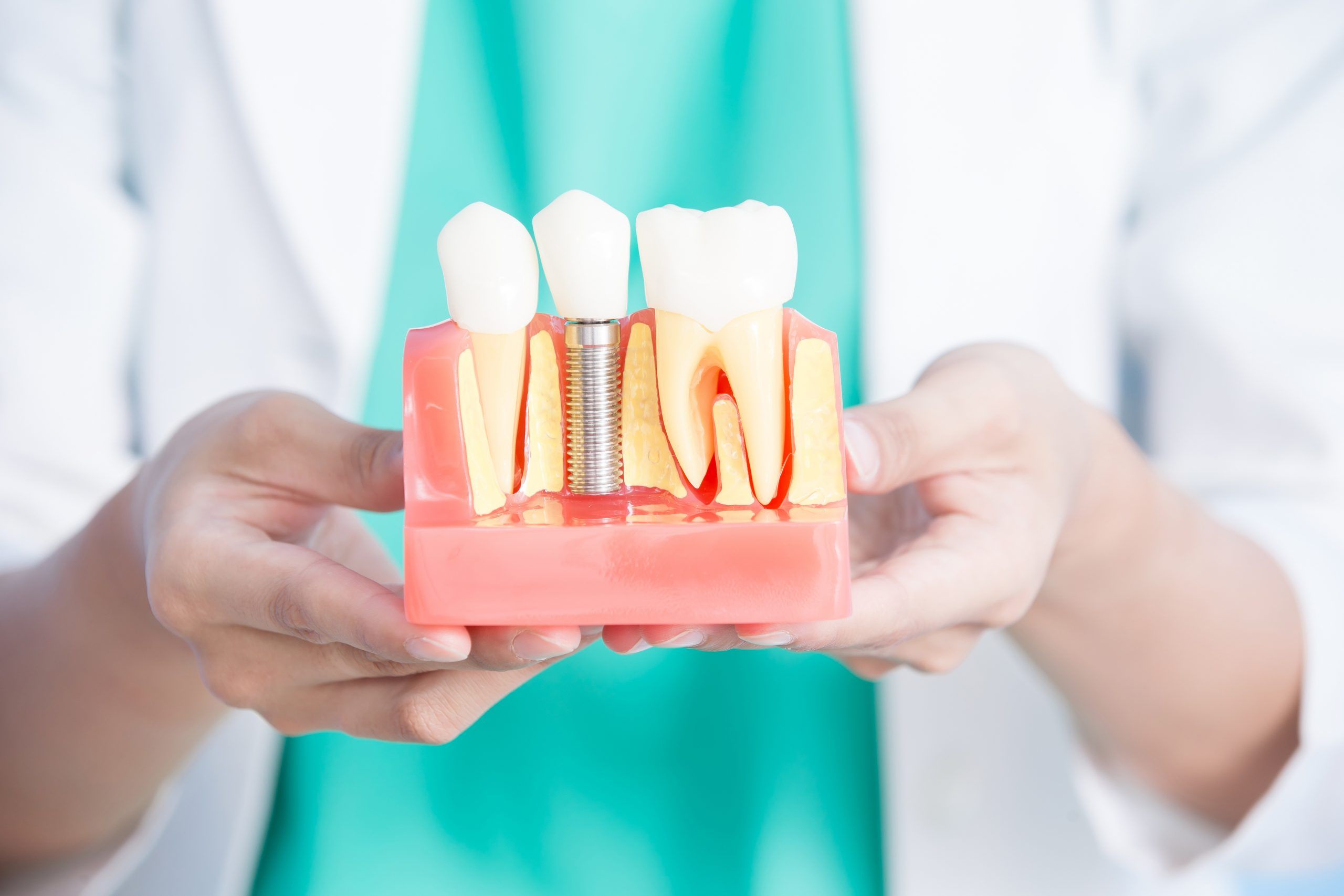 falsos mitos de los implantes dentales