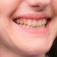 fluorosis dental