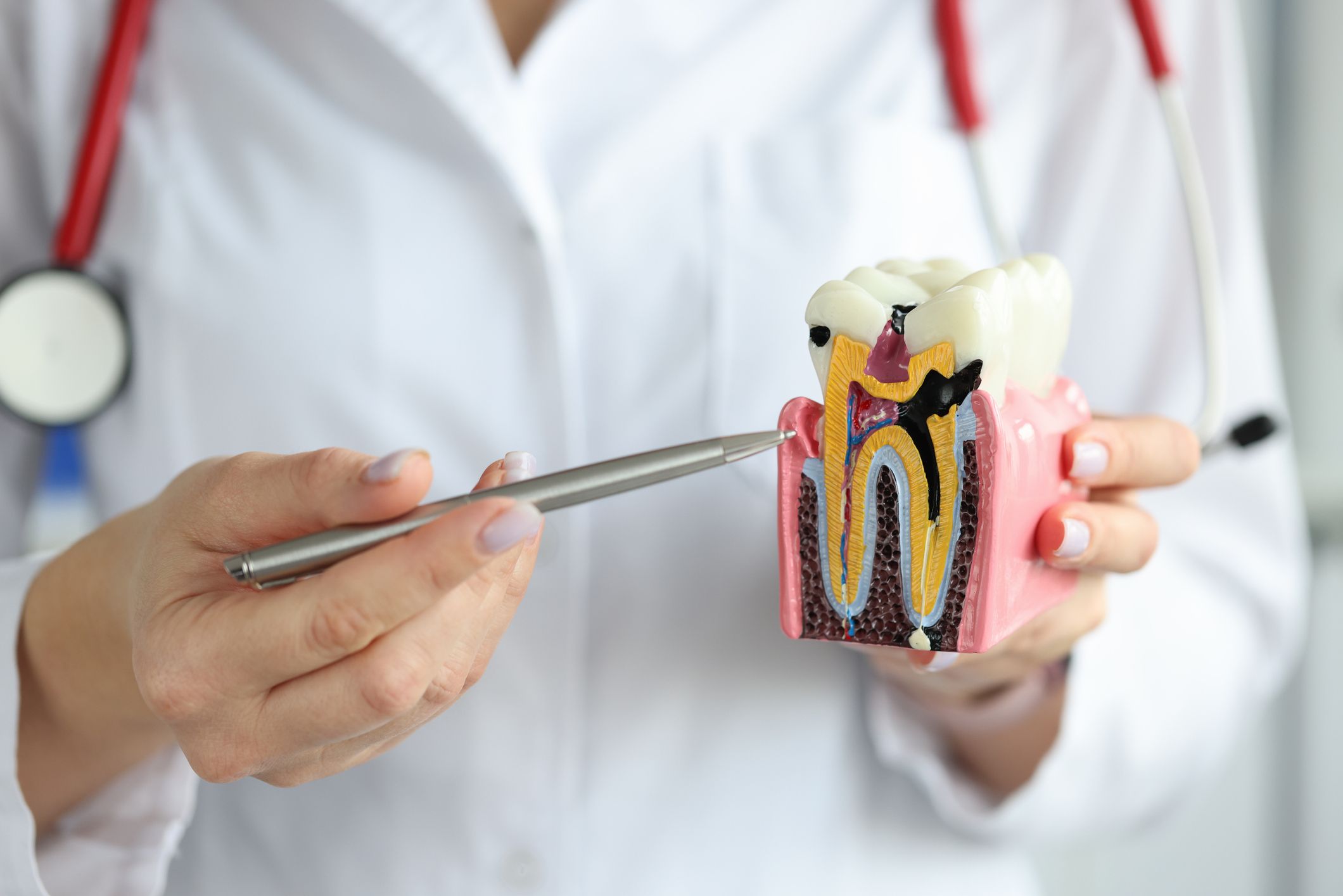 tipos de caries