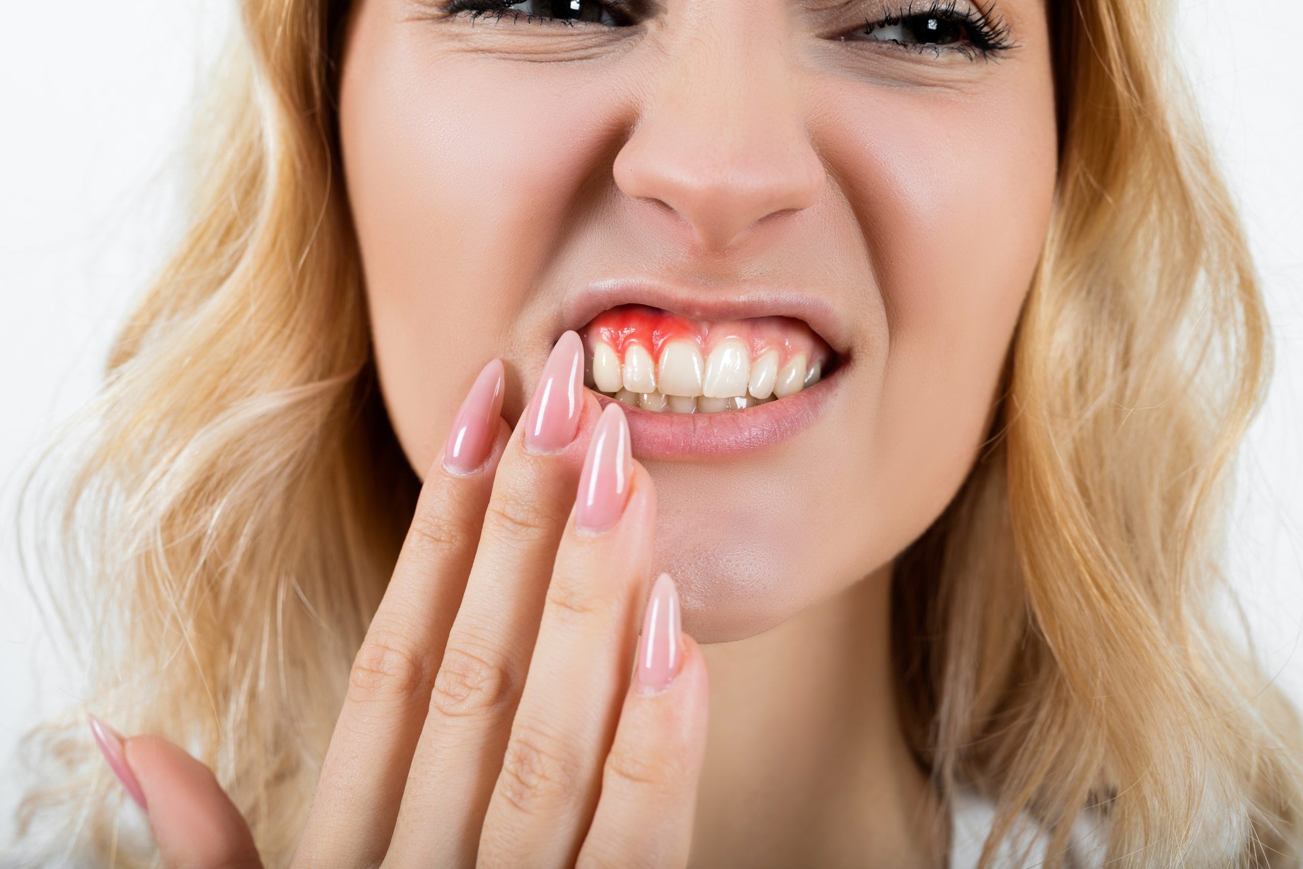 sangrado gingival