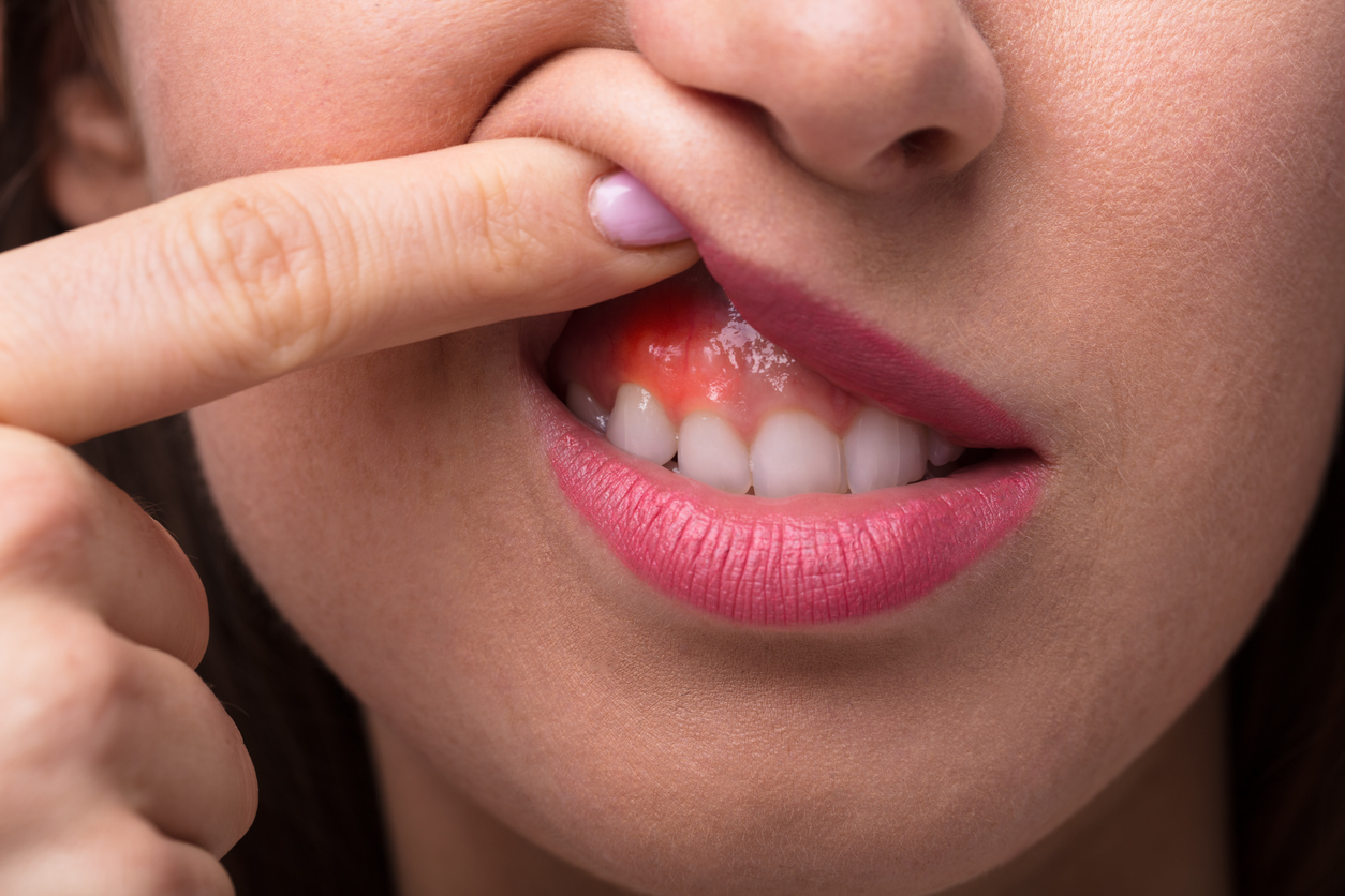 enfermedades periodontales