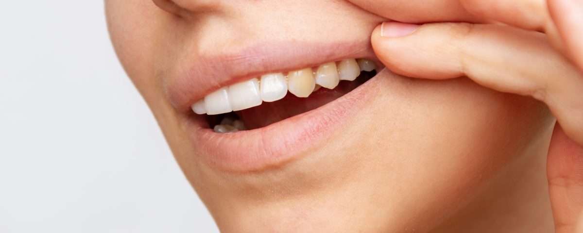 Hipocalcificación del esmalte