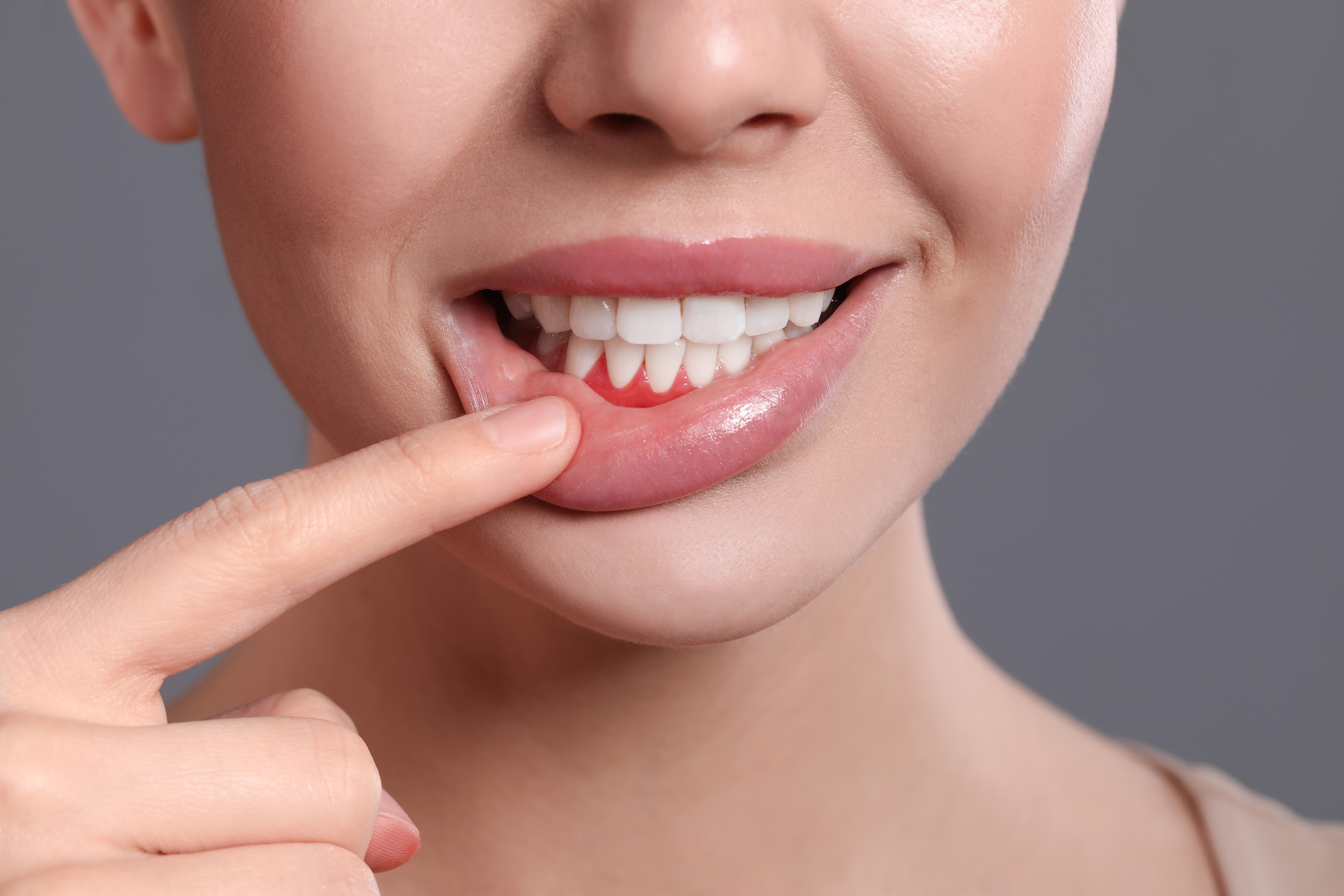 Recesión gingival