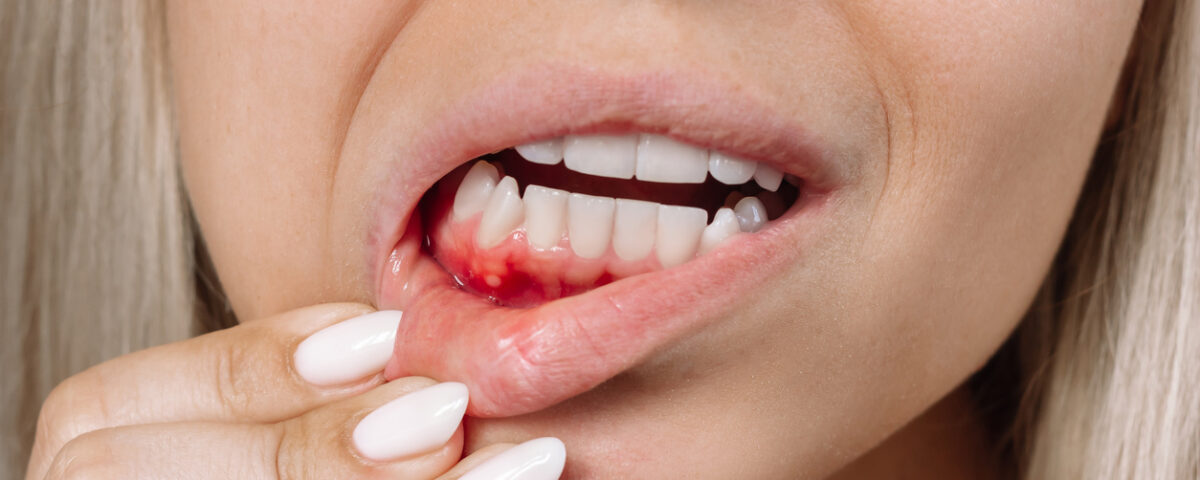 Por qué sangran las encías