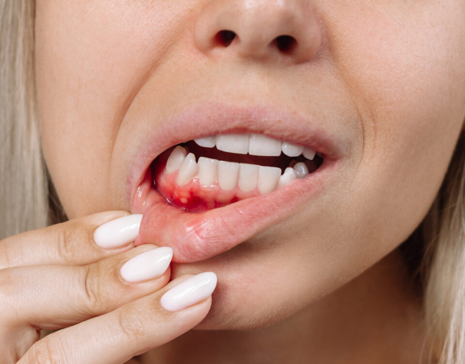 Por qué sangran las encías