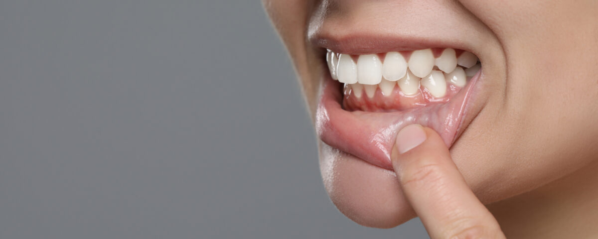 Enfermedades periodontales