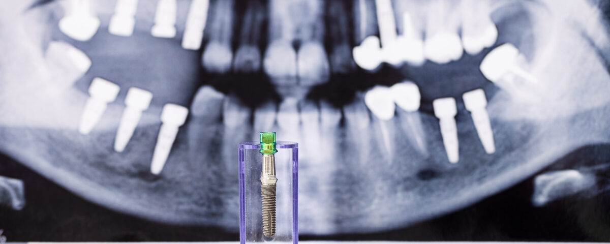 implantes y ortodoncia