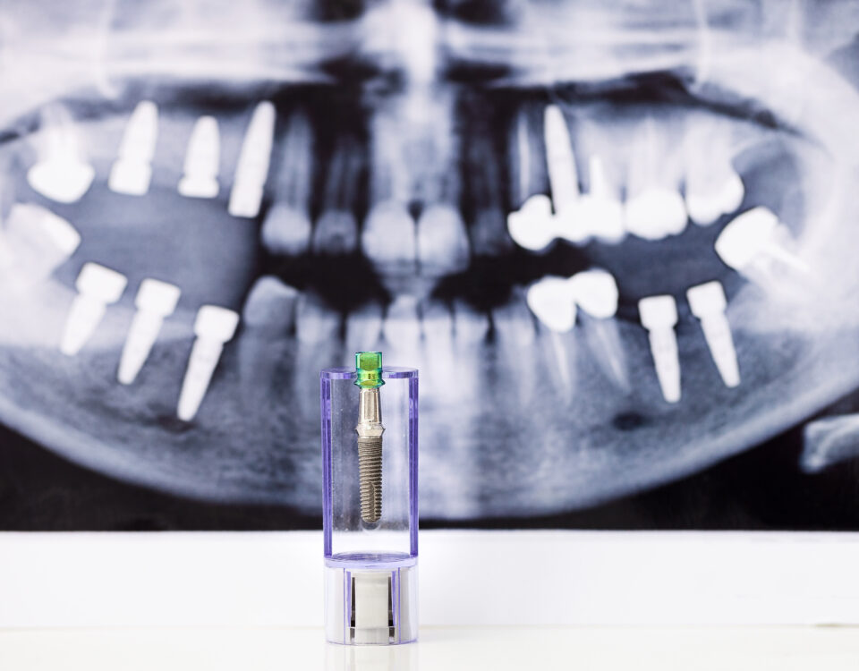 implantes y ortodoncia