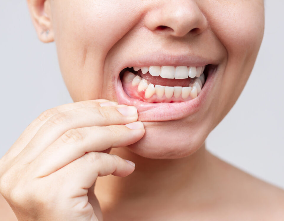 bolsas periodontales