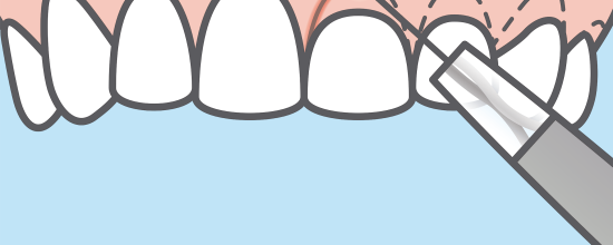 alargamiento coronario