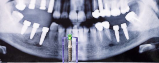 implantes y ortodoncia