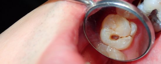 síntomas de la caries