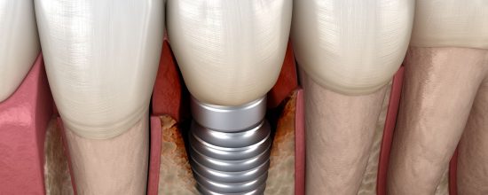 periimplantitis