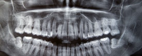 causas pérdida hueso dental