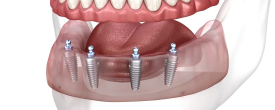 Qué son las prótesis fijas sobre implantes