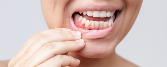 bolsas periodontales