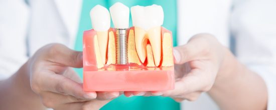 falsos mitos de los implantes dentales